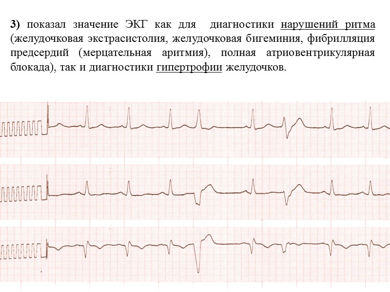 12 3) показал значение ЭКГ как для  диагностики нарушений ритма (желудочковая экстрасистолия, желудочковая